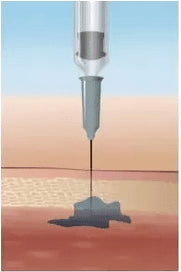 DERMOTECHNIKA - HYALURON PEN - dermes store